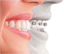 Выравнивание зубов без брекетов прозрачными элайнерами ОртоСнэп